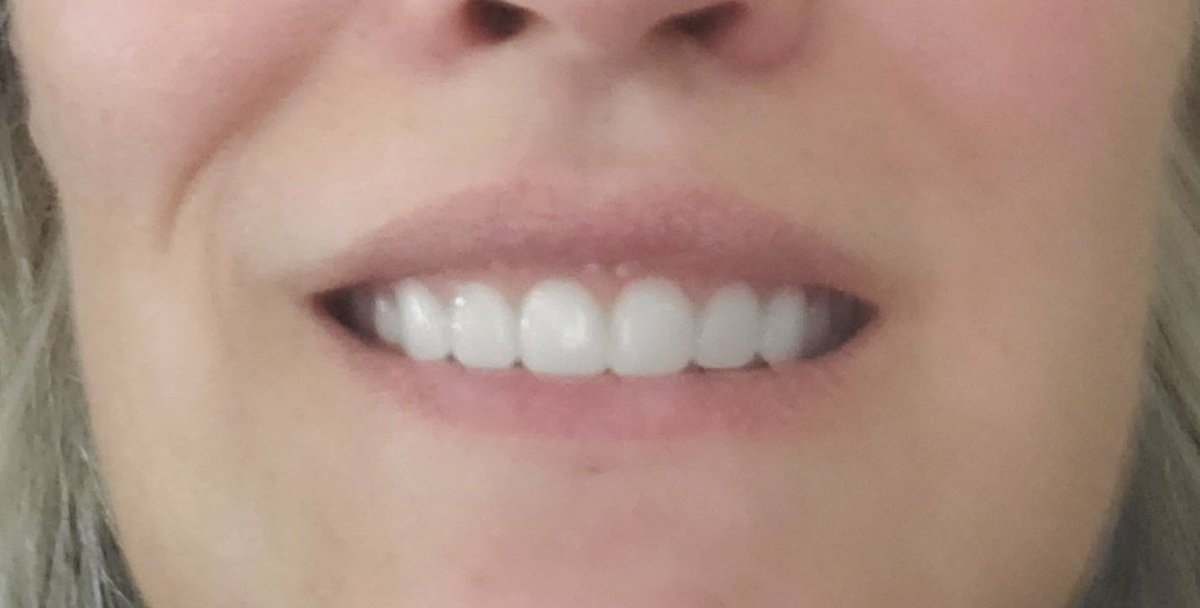 Ok, NOW I'm in pain. Ice pack wrapped around my face. This sucks.