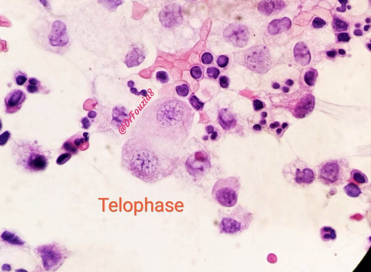 DrFouzia8's tweet photo. Malignant ascites. Atypical mitosis.
Enjoy. 😄 @JMGardnerMD @smlungpathguy @sza_jhcyto @ALBoothMD @DrGeeONE
 @vi_monappa @Gagandeepk5MD @padmapathology1 @Jazzopath1 @Meghna0630 @KMirza @pathridle_susan @DrAHLAMN1 @SaudiCytopathol @IACytology #cytology #pathology #pathspotters https://t.co/gKF0y4b5x4