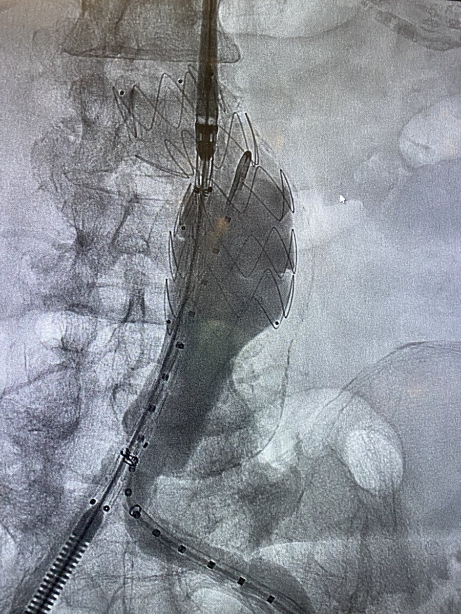 Wide AAA neck and tortuous. Poor surgical candidate. I placed a thoracic cuff first (skirt technique) Endurant bifur low in the aorta and a bridging piece + endostapling.  @t_intheleadcoat  @SIRspecialists  @vascsvssj  #EVAR  #ANEURYSM  #medtronics  #aorta