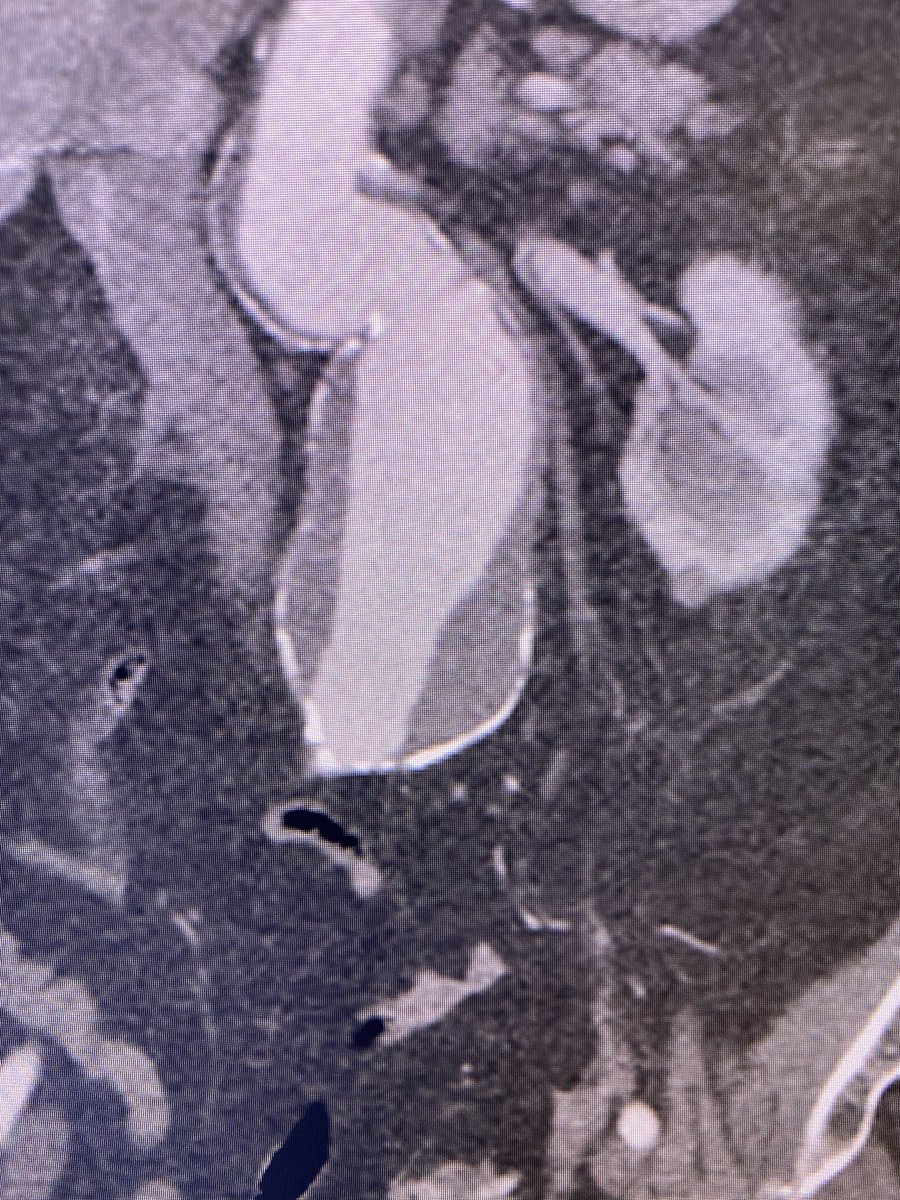 Wide AAA neck and tortuous. Poor surgical candidate. I placed a thoracic cuff first (skirt technique) Endurant bifur low in the aorta and a bridging piece + endostapling.  @t_intheleadcoat  @SIRspecialists  @vascsvssj  #EVAR  #ANEURYSM  #medtronics  #aorta