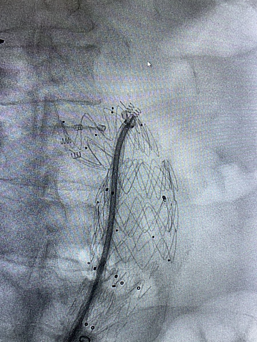 Wide AAA neck and tortuous. Poor surgical candidate. I placed a thoracic cuff first (skirt technique) Endurant bifur low in the aorta and a bridging piece + endostapling.  @t_intheleadcoat  @SIRspecialists  @vascsvssj  #EVAR  #ANEURYSM  #medtronics  #aorta