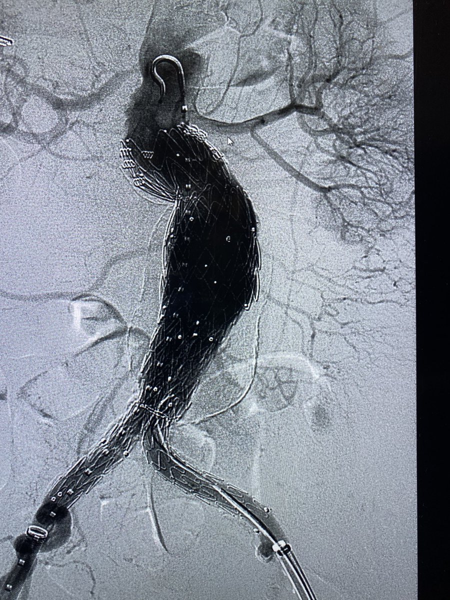 Wide AAA neck and tortuous. Poor surgical candidate. I placed a thoracic cuff first (skirt technique) Endurant bifur low in the aorta and a bridging piece + endostapling.  @t_intheleadcoat  @SIRspecialists  @vascsvssj  #EVAR  #ANEURYSM  #medtronics  #aorta