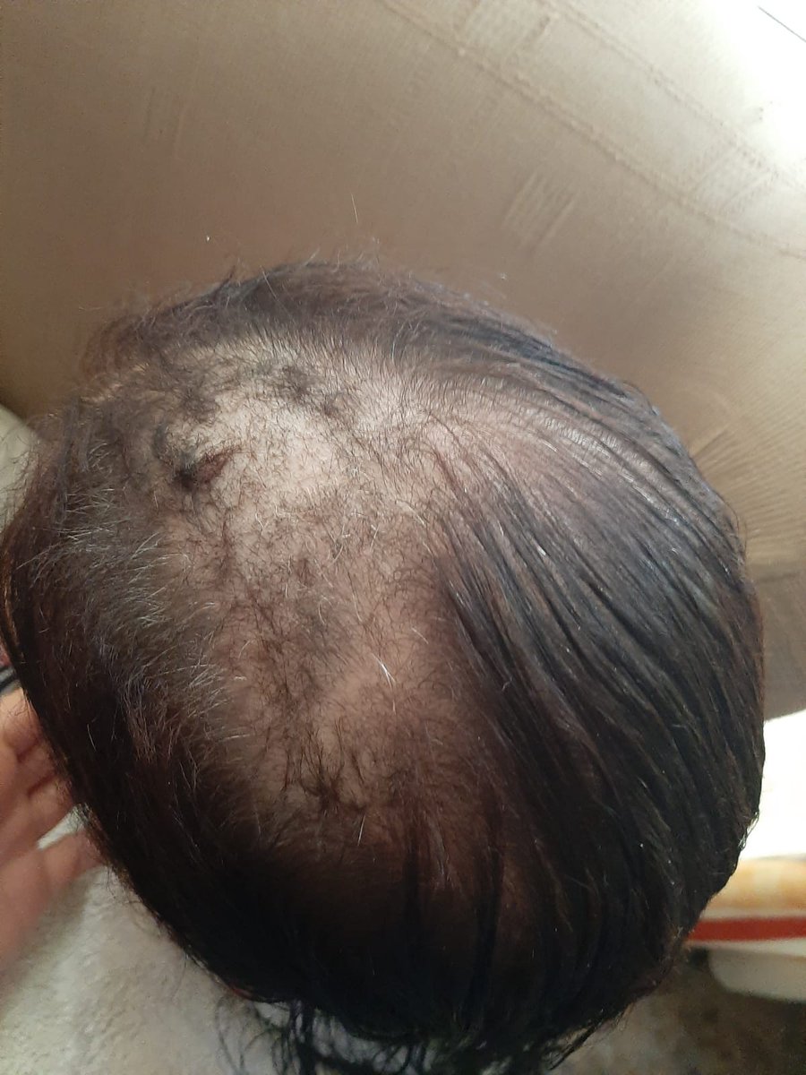 joseelee3's tweet photo. Tened muchísimo cuidado con esta mascarilla del Mercadona, le ha quemado el pelo a mi madre y se le ha caído casi todo el pelo. 
La solución que le ha dado el médico es raparse y comenzar un tratamiento (veremos lo que cuesta).

Repair and nutrition? Me cago en sus muertos. https://t.co/thBcom7dO7