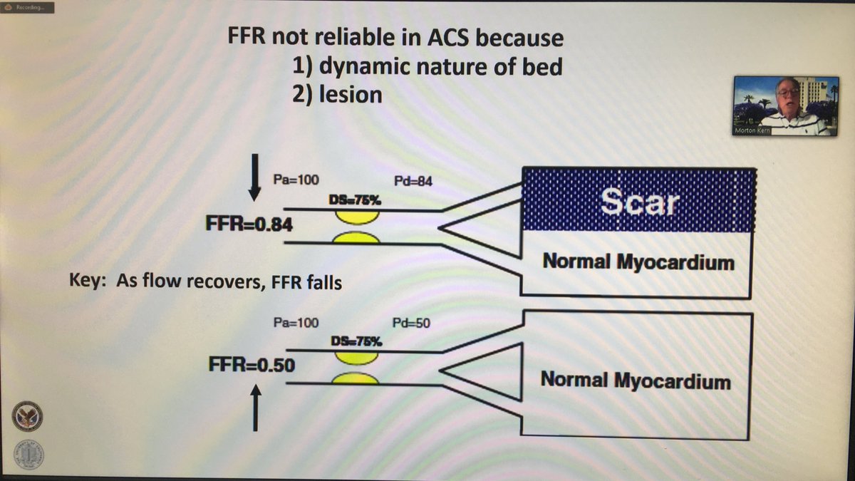 Iowa Chapter of the American College of Cardiology (@iowaacc) on Twitter photo Second part of @drmortkern’s lecture focusing on “Intracoronary physiology” during <a href="/IowaACC/">Iowa Chapter of the American College of Cardiology</a> and ACC Early Career Section “Interventional Cardiology Board Review”. <a href="/ACCinTouch/">American College of Cardiology</a> <a href="/MahiAshwath/">Mahi Ashwath</a> <a href="/Pooh_Velagapudi/">Poonam Velagapudi</a> <a href="/SDRoyMD/">Shubha Deep Roy, MD, FACC, FASE, FASNC, FSCAI</a> <a href="/MeeraKondapane1/">Meera Kondapaneni</a> <a href="/tilakpasala/">Tilak Pasala</a> Second part of @drmortkern’s lecture focusing on “Intracoronary physiology” during <a href="/IowaACC/">Iowa Chapter of the American College of Cardiology</a> and ACC Early Career Section “Interventional Cardiology Board Review”. <a href="/ACCinTouch/">American College of Cardiology</a> <a href="/MahiAshwath/">Mahi Ashwath</a> <a href="/Pooh_Velagapudi/">Poonam Velagapudi</a> <a href="/SDRoyMD/">Shubha Deep Roy, MD, FACC, FASE, FASNC, FSCAI</a> <a href="/MeeraKondapane1/">Meera Kondapaneni</a> <a href="/tilakpasala/">Tilak Pasala</a>