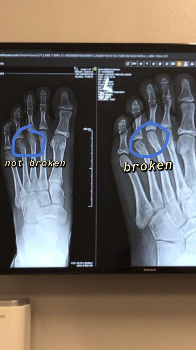 scubawilliams1's tweet photo. “X” is for x-ray - my son- Trevor broke his toes. $$$ “M” is for money spent on xrays, doctor appointments & boot for his recovery. Fun way to enjoy our summer! #riverasummerabcs @MarvynCWhite @melrbates @RiveraElem https://t.co/Po8jydgXR6