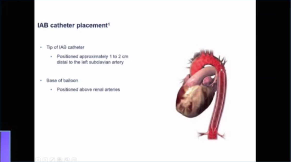 Intra-aortic balloon pumpDiastolic augmentation,  MAP during augmented beat afterload and end-diastolic pressureCO augmentation 0.7-1.4 l/minPosition: IABP tip at carina level on CXR