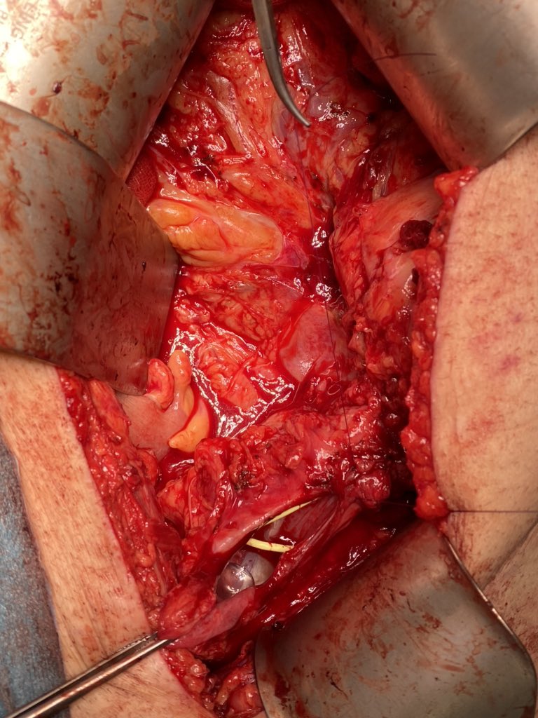 Treatment of ureteral stricture following renal transplantation with Boari flap. The use of a Boari flap provides a well vascularize conduit to span the gap between the bladder and allograft collecting system @TrasplanteAEU @ONT_esp @HospitalULaPaz @IdipazScience @Biobanco_Idipaz