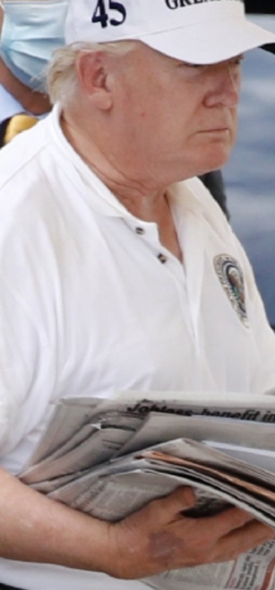 rotophonic's tweet photo. What the F is happening with Trump’s hand this morning? That’s a weird bruise from an IV. RN’s? Doctors? Care to comment? #TrumpHand https://t.co/bOsfxKxrrh
