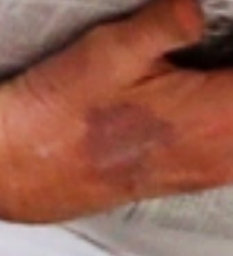 rotophonic's tweet photo. What the F is happening with Trump’s hand this morning? That’s a weird bruise from an IV. RN’s? Doctors? Care to comment? #TrumpHand https://t.co/bOsfxKxrrh