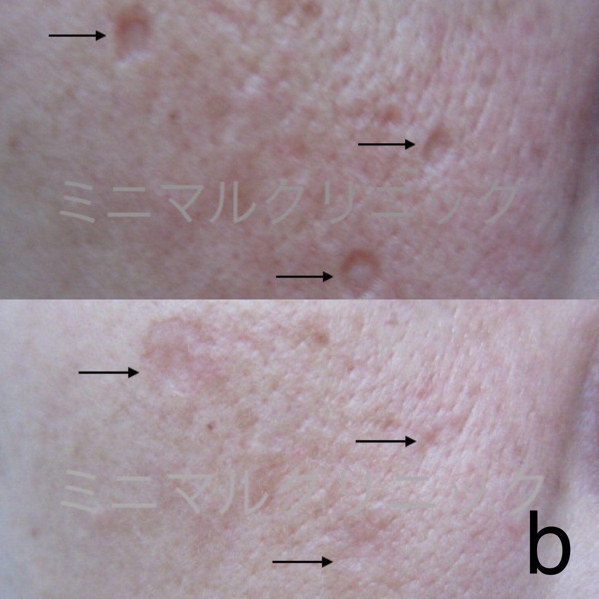 תג 水疱瘡痕 בטוויטר