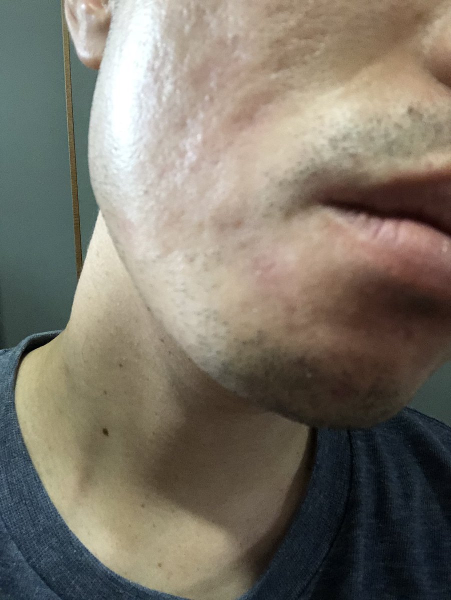 肌中心の男 トレチノインのおかげで 右の顎あたりの色素沈着は薄くなってきた 左はまだまだ赤みもあるので こちらにはルミキシル塗っていこうかな