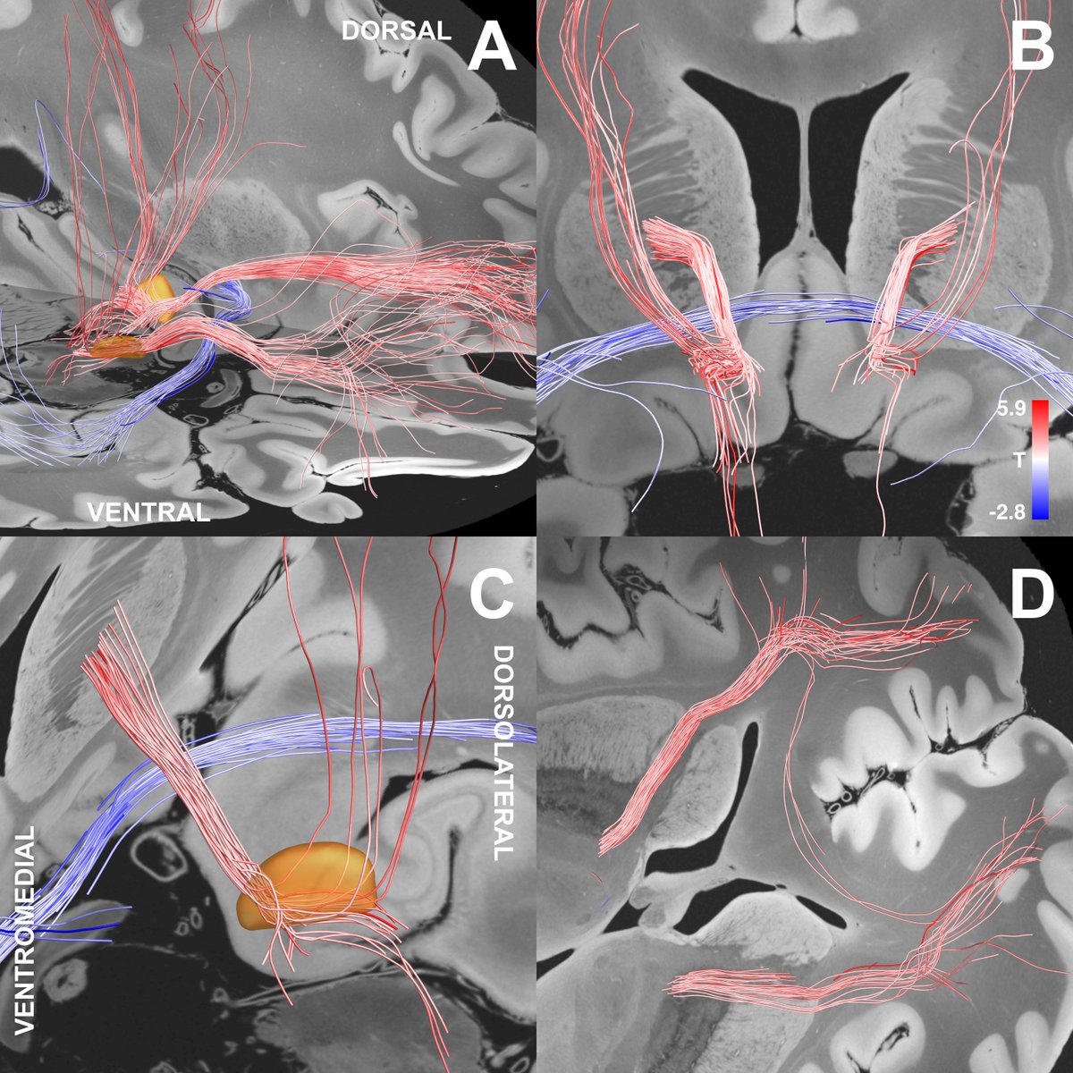 Second, the tract we isolated does indeed traverse exactly within the anteromedial STN. Again – this is using dMRI-tractography for anatomical conclusions and should not be overinterpreted.
