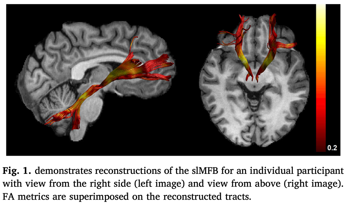 Finally, other authors have begun to mislabel the MFB, e.g. here in schizophrenia. The bundle shown is a beautiful internal capsule and even connects to the cerebellum.  http://doi.org/10.1016/j.nicl.2019.102044