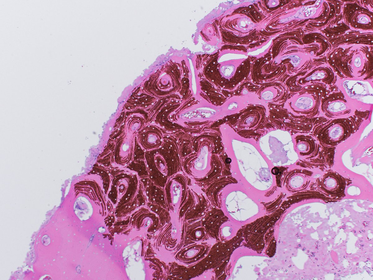 elworswick's tweet photo. Saw this on an osteomyelitis case last week. Some kind of artifact made all the osteons stand out. Isn't it pretty? #pathart https://t.co/jl8DchFFfp
