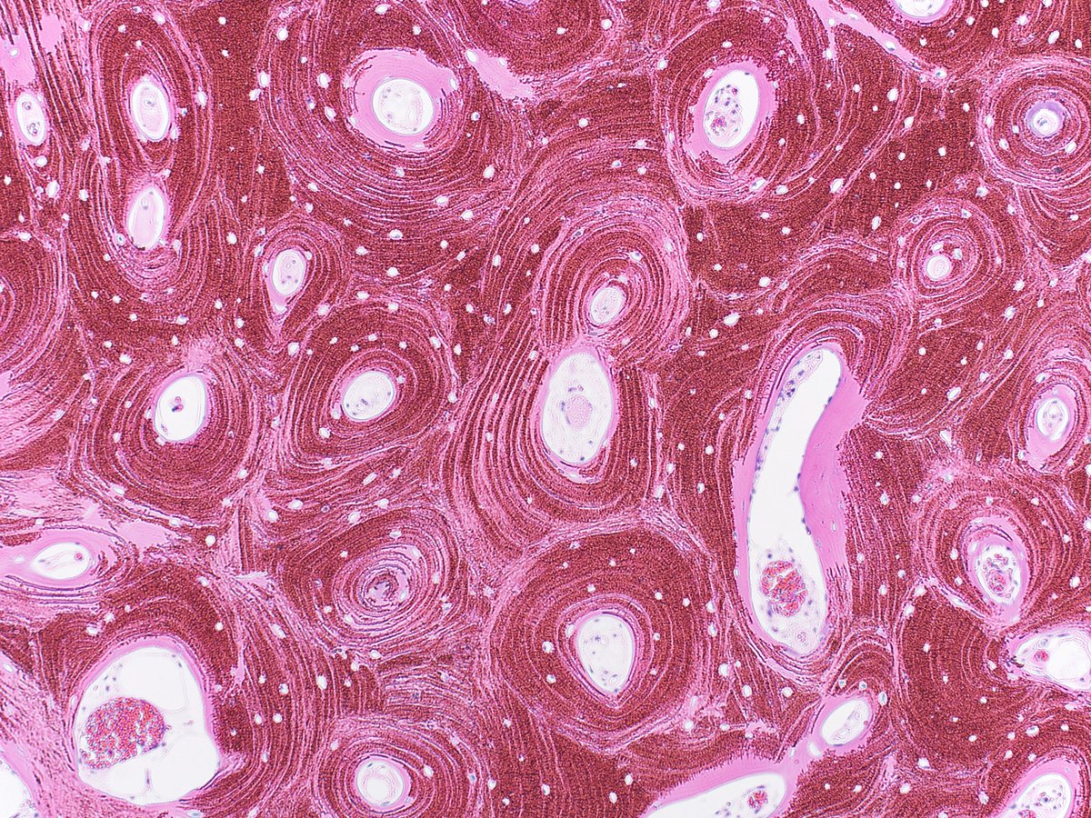elworswick's tweet photo. Saw this on an osteomyelitis case last week. Some kind of artifact made all the osteons stand out. Isn't it pretty? #pathart https://t.co/jl8DchFFfp