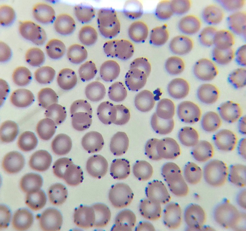 Para los expertos que afirman que no sé nada y que me ponga a estudiar ruego me expliquen que son estás inclusiones eritrocitarias si no son hemoparasitos. La tincion y colorantes están perfectos así que no va por ahí.