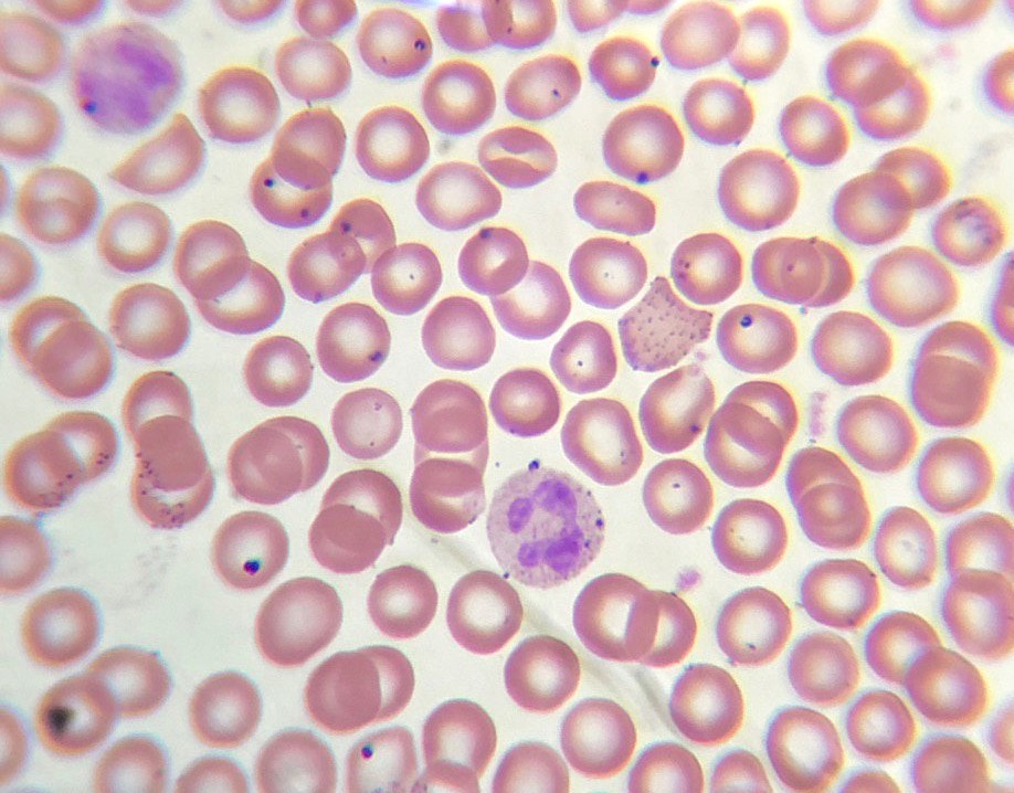 Para los expertos que afirman que no sé nada y que me ponga a estudiar ruego me expliquen que son estás inclusiones eritrocitarias si no son hemoparasitos. La tincion y colorantes están perfectos así que no va por ahí.