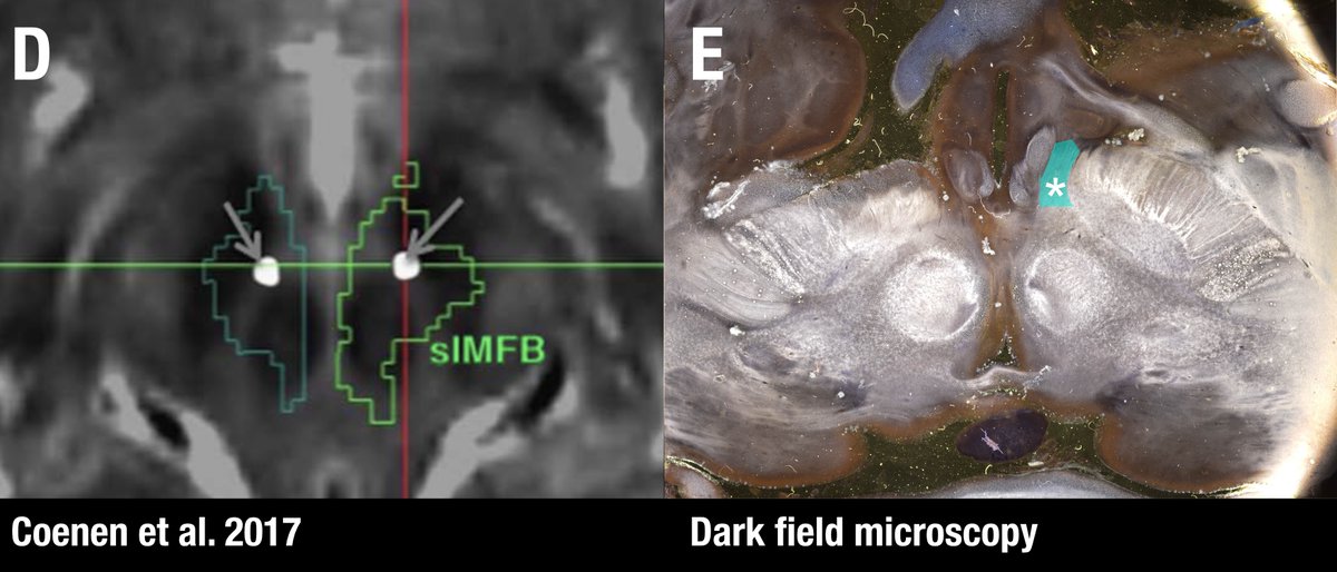 Contrasting the axial definition of the sl-MFB (Coenen et al. 2017) to a dark-field microscopy section kindly provided by  @eduardo_alho shows tha the true (anatomical) MFB) traverses through the hypothalamus to the olfactory cortex.