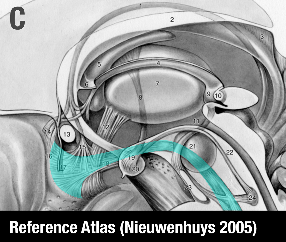 The MFB is a bundle that was predominantly characterized in the rat. One of the few people that published original work on it is Rudolf Nieuwenhuys – in his handbook, the MFB does not traverse within the anterior commissure.