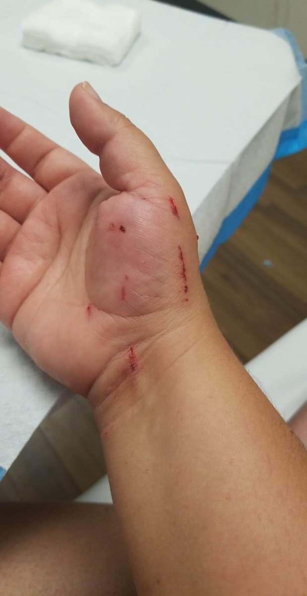 Phoenix28432828's tweet photo. @JacksonGalaxy So this happened while trying to leash train my cat. Something spooked her and i was going to get bit or she was going to strangle herself. https://t.co/cXl5a05vgr