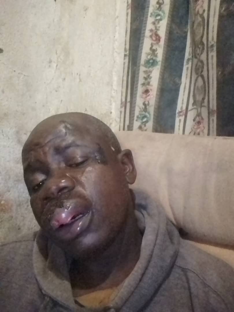 EdmundKudzayi's tweet photo. On August 5, a father failed get transport out of town. He only managed to get back to Mabvuku at 7pm after 6PM curfew and was brutally assaulted by soldiers. His name is David Mutendera. He could be your father or mine. Is this a free Zimbabwe governed by the rule of law? https://t.co/mDrHOvvO0n