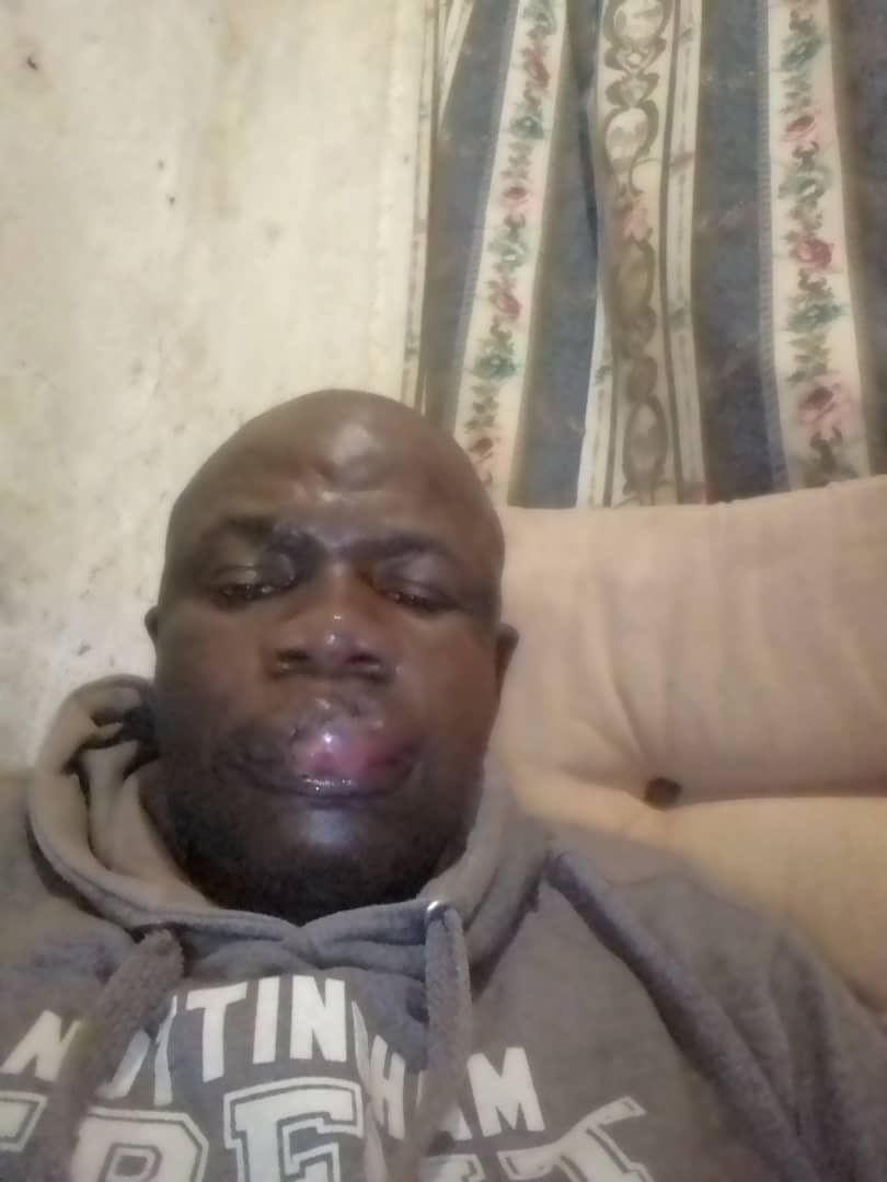 EdmundKudzayi's tweet photo. On August 5, a father failed get transport out of town. He only managed to get back to Mabvuku at 7pm after 6PM curfew and was brutally assaulted by soldiers. His name is David Mutendera. He could be your father or mine. Is this a free Zimbabwe governed by the rule of law? https://t.co/mDrHOvvO0n