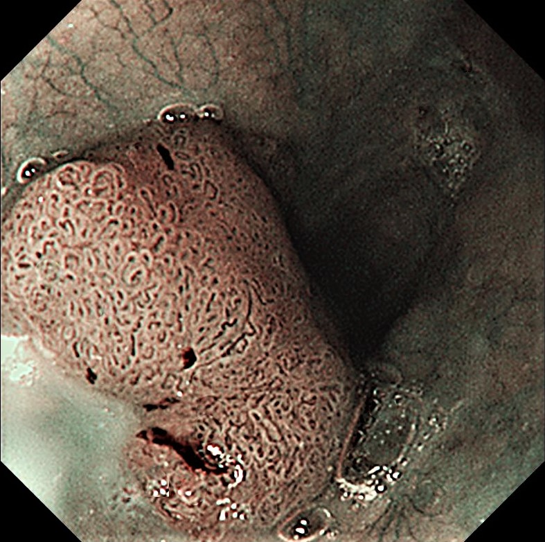 Esophageal adenocarcinoma (Diagnostic criteria in Japan) arose in Ce of esophagus, most likely ectopic gastric mucosa origin. Esophagus, biopsy. #pathology #pathologist #GIpath