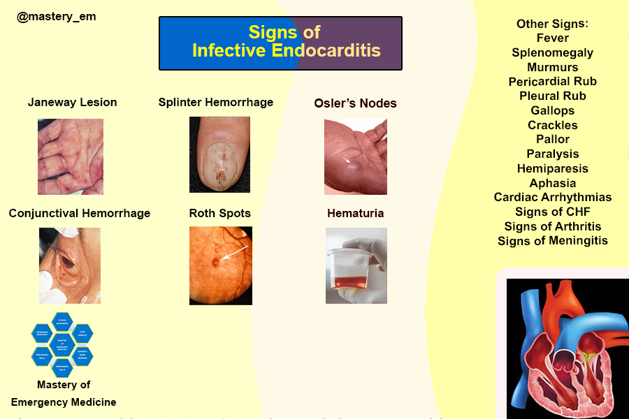 Infective Endocarditis Signs And Symptoms