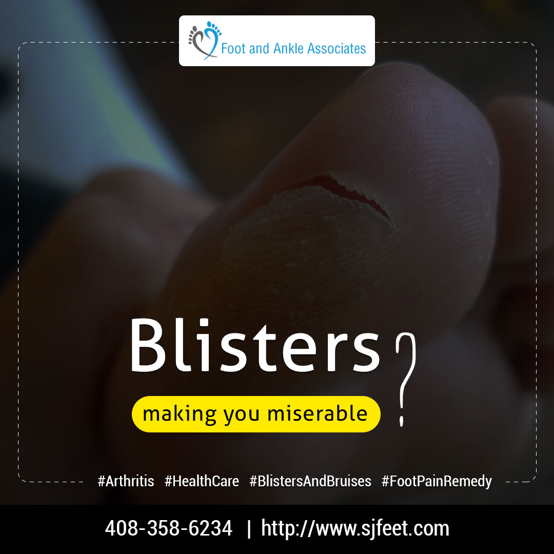 Blisters making you miserable? Visit bit.ly/2UJ0RJc for foot treatment! #Feet #Doctor #Medicine #Treatments #Health #Podiatrist #FootCare #Physiotherapist #Arthritis #HealthCare #BlistersAndBruises #FootPainRemedy #OrthoticInsoles #AlwaysHere #TheStruggleIsReal