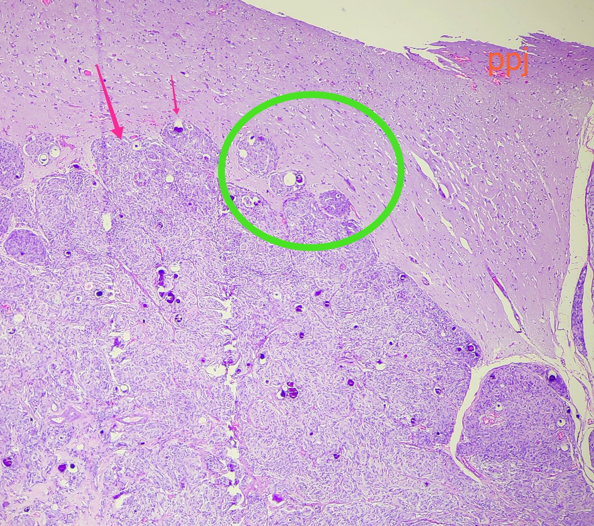 padmapathology1's tweet photo. #neuropath #pathology While defining #BrainInvasion for Atypical meningioma, what do foci such as ⬇️ mean? There is no reaction around the islands. Multiple resections looks mandatory. Any other practice suggested in such cases? @FRodriguezNP @CraigHorbinski @mlage @anushasbhatt https://t.co/pcrEOVxcu1