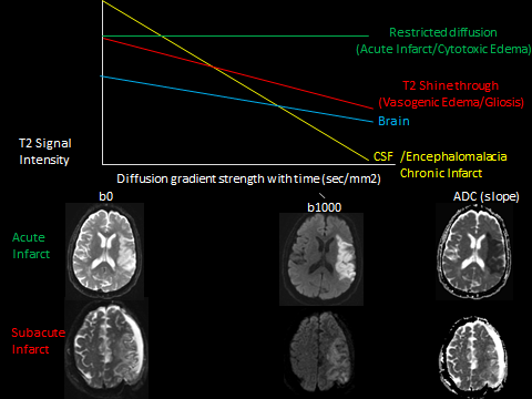 Hammerdongle's tweet photo. DWI stroke physics

Proton diffusion correlates with T2 signal loss on b1000. ADC signal intensity correlates with the degree of proton diffusion and T2 signal loss. 

Proton diffusion: CSF > brain > cytotoxic edema

#FOAMed #FOAMrad #radres #NeuroRad #radiology #Neurology https://t.co/O8wvP6nnKQ