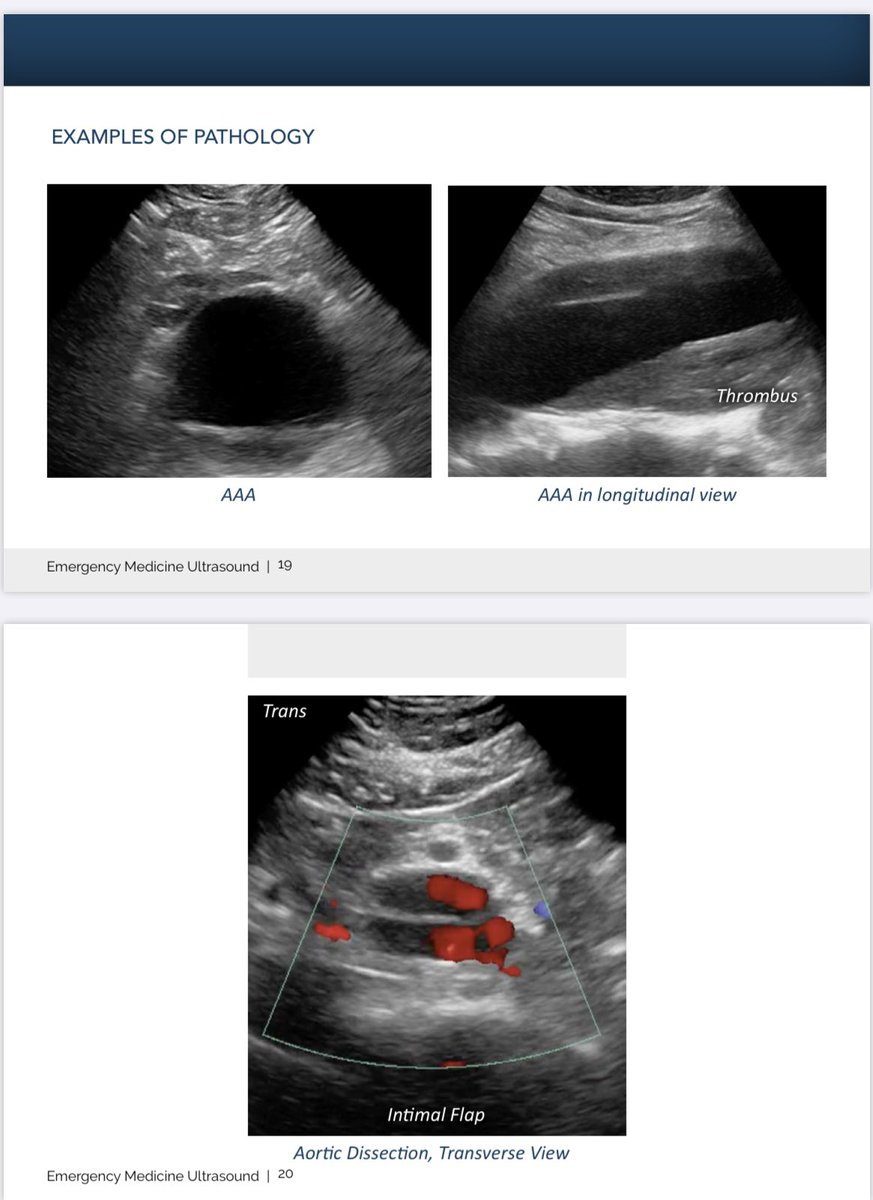 Blood, sweat, and tears went into making this #POCUS EM U/S Pocketbook Guide with the help of <a href="/KRMC_EM/">Kendall EM Residency - MIAMI, FL</a> U/S director <a href="/moremois/">Moises Moreno</a>. Perfect for interns up to attendings and fits in your lab coat: amzn.to/3ii218b
