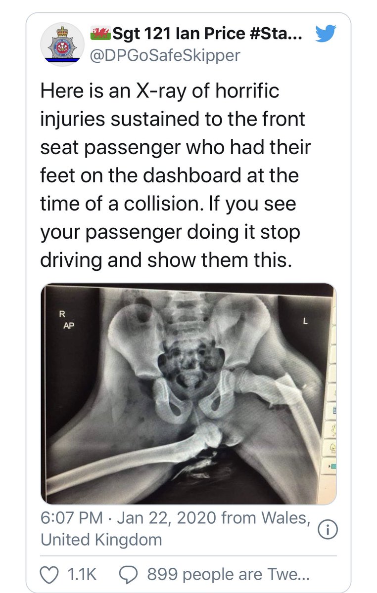 Avec la caution Police, le message est encore plus fort ... "Police share shocking X-ray to show why you should not put your feet on car dashboards"