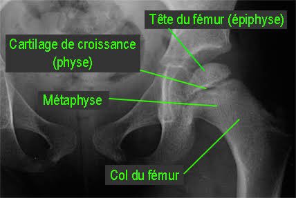 Mais celle d'un enfant... comme on peut le voir ici (fléchés) car les cartilages de croissance des fémurs ne sont pas soudés (le trait noir entre l'epiphyse et la métaphyse) contrairement à une hanche adulte. (Il y a d'autres signes en faveur d'un enfant)