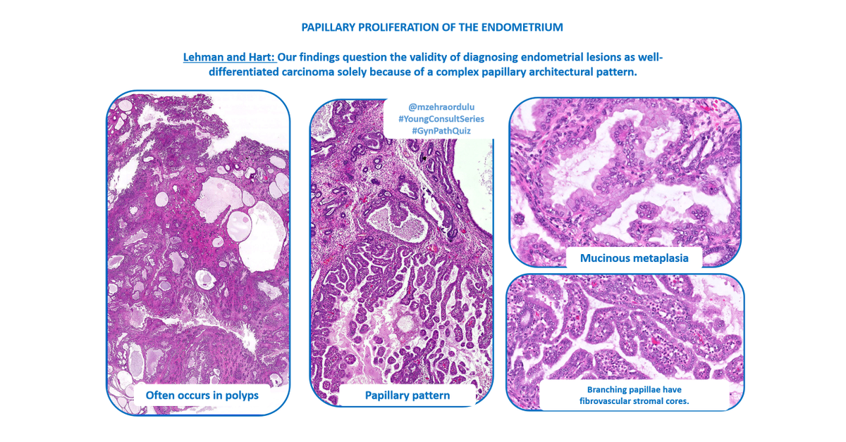 mzehraordulu's tweet photo. RHY: Papillary proliferation of the endometrium.
🌟Described by Lehman and Hart.
🌟often occurs in polyps and shows mucinous metaplasia. 
🌟Papillary proliferation is not immune from also showing atypical hyperplasia, which is not seen here.
🌟DDx: Villogland. end CA. https://t.co/mczhzw7oA8