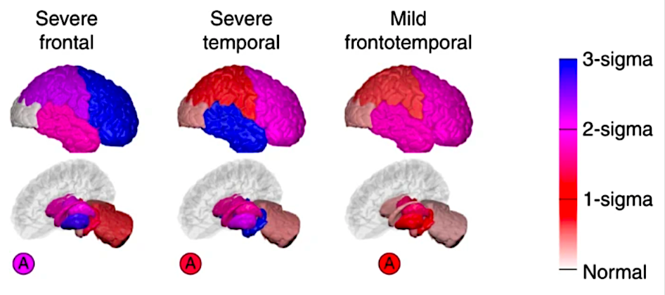 PTenigma's tweet photo. When a DISEASE like #Alzheimer's has many SUBTYPES - how do you disentangle a patient's SUBTYPE+disease STAGE? Dr Alexandra Young's remarkable SuStaIn algorithm shows how: Dr Leon Aksman ties tau-1st and amyloid-1st #Alzheimer's to CSF predictors #AAIC20 https://t.co/1Vxj2tYFml https://t.co/ZMxqc89cYk