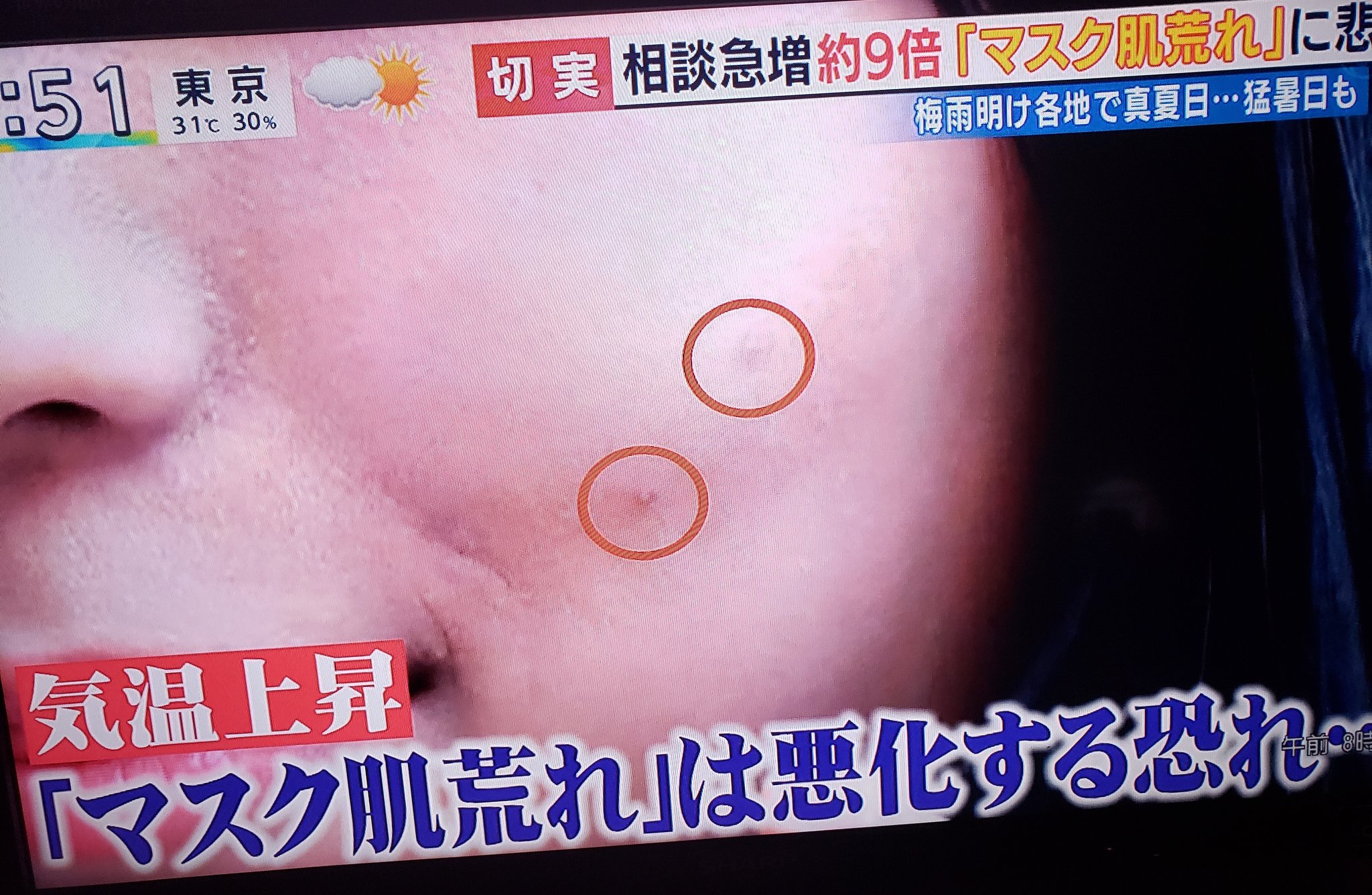 みゆ マスク肌荒れ マスクして擦れて肝斑 シミ が濃くなるという恐ろしさ マスク頭痛 マスク外す時には毎回保湿か ミスト系のよさそう スプレータイプのあるし マスク肌荒れ対策は 触れる所にガーゼ と みゆ マスク肌荒れ マスクして擦れて肝斑 シミ が濃くなるという恐ろしさ マスク頭痛 マスク外す時には毎回保湿か ミスト系のよさそう スプレータイプのあるし マスク肌荒れ対策は 触れる所にガーゼ と