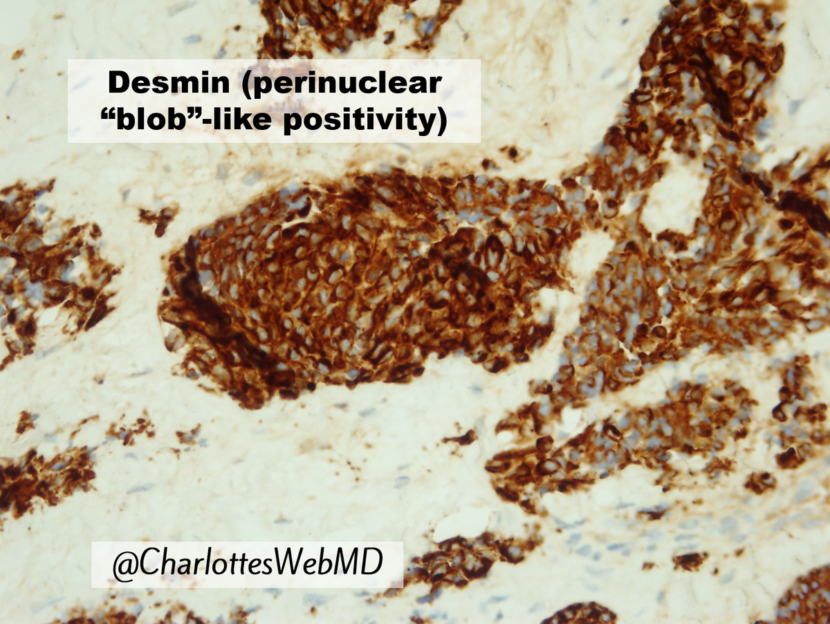 CharlottesWebMD's tweet photo. Desmoplastic small round cell tumor, as Rosai once said, is not always desmoplastic nor always small! But, here are a few DSRCT truths:
🔹Always in the ddx for "peritoneal carcinomatosis" in kids
🔹Stains positive for WT1 C terminus but not for N terminus (unlike Wilms) https://t.co/yvst3x8EWd