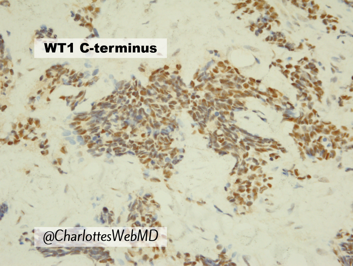 CharlottesWebMD's tweet photo. Desmoplastic small round cell tumor, as Rosai once said, is not always desmoplastic nor always small! But, here are a few DSRCT truths:
🔹Always in the ddx for "peritoneal carcinomatosis" in kids
🔹Stains positive for WT1 C terminus but not for N terminus (unlike Wilms) https://t.co/yvst3x8EWd