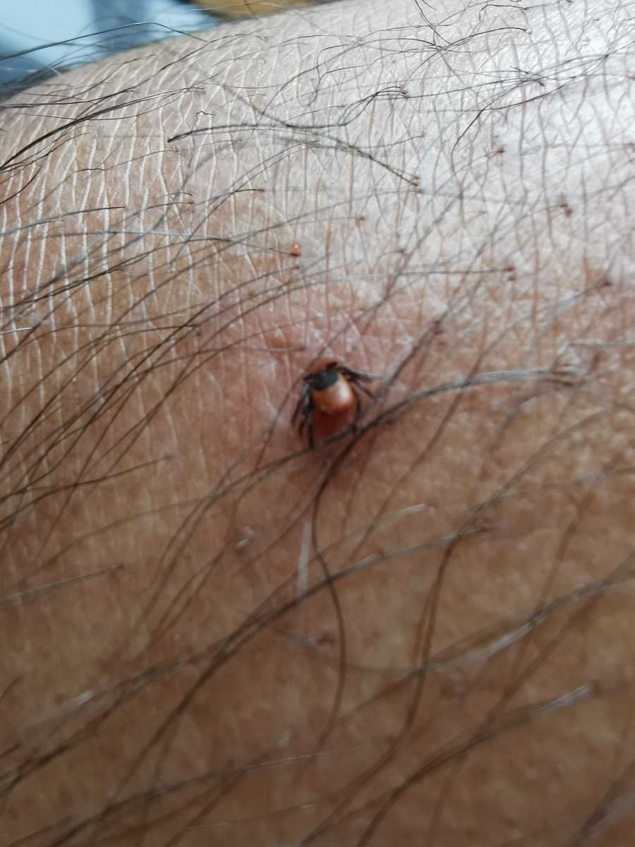 bnrjt07's tweet image. #Lymedisease #tickaware This little fella on my knee only after 18 hrs following a trail walking: don't forget self check and kids: visitors of the  islands pls keep Lyme ds in mind in the following weeks rash fever joint pain-pls RT @IslesWeather @LymeResearch