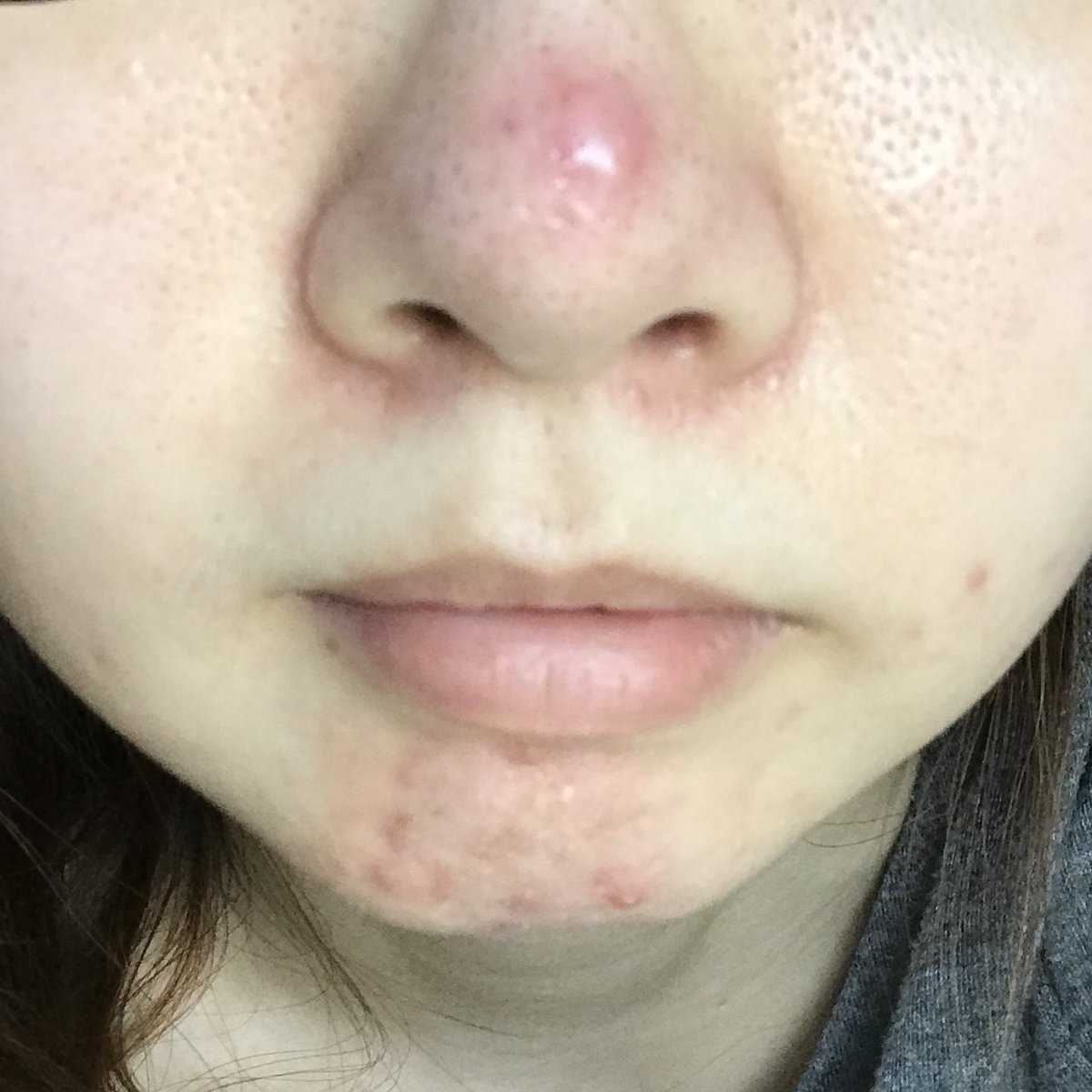 ニキビ撲滅夫婦 妻の顎ニキビを治そうの会 Nikibifu Fu Twitter