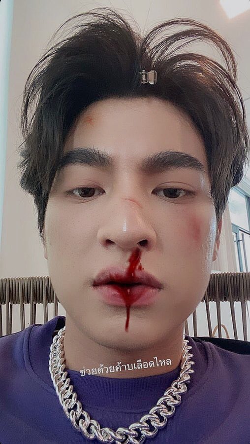 isuseve's tweet photo. ใส่แผลละโหดขึ้นปะ 
พึ่งไปตีกับแก๊งหน้าปากซอยมา ไรงี้ https://t.co/SPZJXNvbVG