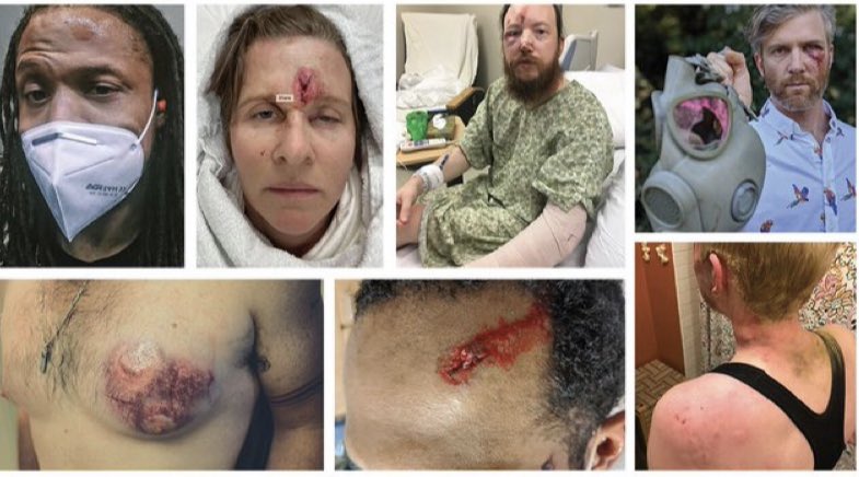 These are some of the injuries incurred by rioters outside the Portland courthouseRioting is a dangerous act, I received some pretty direct hits one of which seems to have fractured my shin These aren’t victims, Feds gave many warnings before crowd control munitions were used