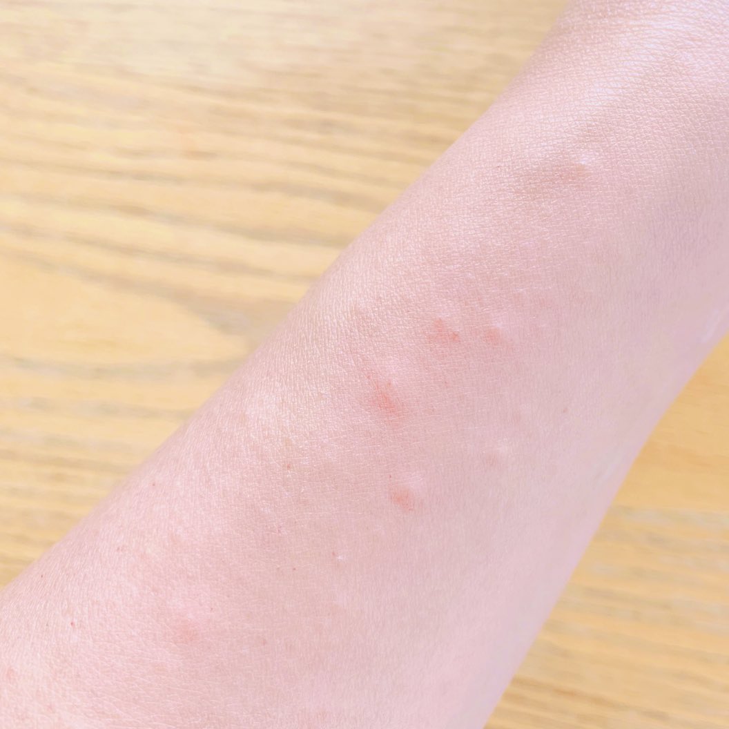 日光湿疹 Twitter Search