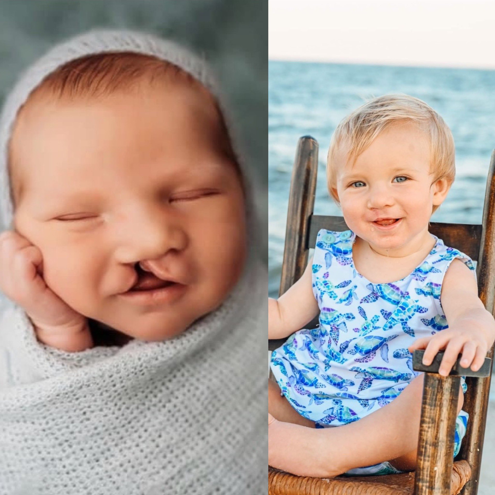 Mia Moo Fund on X: "Meet Owen💙 He is from Alabama and was born with a  unilateral cleft lip as well as a cleft palate. He had his first lip repair  surgery