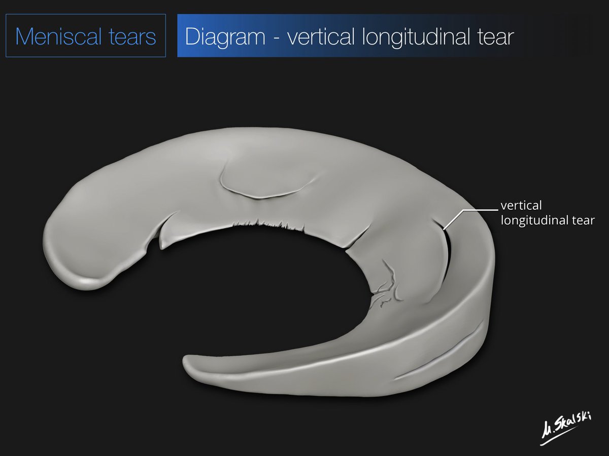 My meniscal tear lecture is the current free @Radiopaedia featured video. Plenty of tips, MRI case examples and beautiful illustrations by @docskalski. WATCH: Radiopaedia.org/courses/featur… #foamed #foamrad #orthotwitter #radres