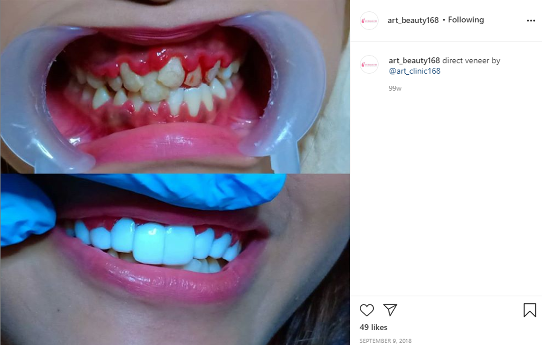 Veneer yang shining, shimmering, splendid itu hanyalah pengalihan isu.

Masalah utama ada di gusi yang meradang dan tampak mudah berdarah yang kelak tanpa perawatan akan berlanjut ke peradangan jaringan pendukung gigi dan kegoyahan gigi.

Via: art_beauty | ig