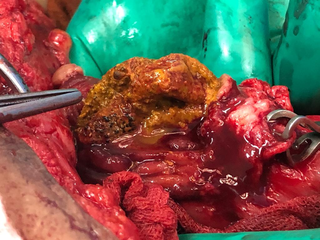 pramodhchan's tweet photo. 71 year old Male previous R.hemi &amp; composite mesh repair of ant abd wall. Lap for metachronus sigmoid ca. SB mass adhered to the scar. Enterotomy reveals migrated mesh in SB , asymptomatic .#colorectalsurgery #meshmigration https://t.co/pIqYV9RGdP