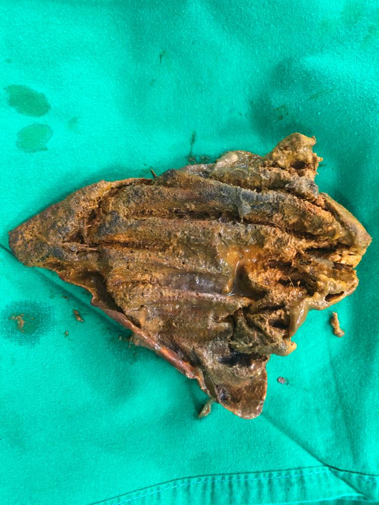 pramodhchan's tweet photo. 71 year old Male previous R.hemi &amp; composite mesh repair of ant abd wall. Lap for metachronus sigmoid ca. SB mass adhered to the scar. Enterotomy reveals migrated mesh in SB , asymptomatic .#colorectalsurgery #meshmigration https://t.co/pIqYV9RGdP