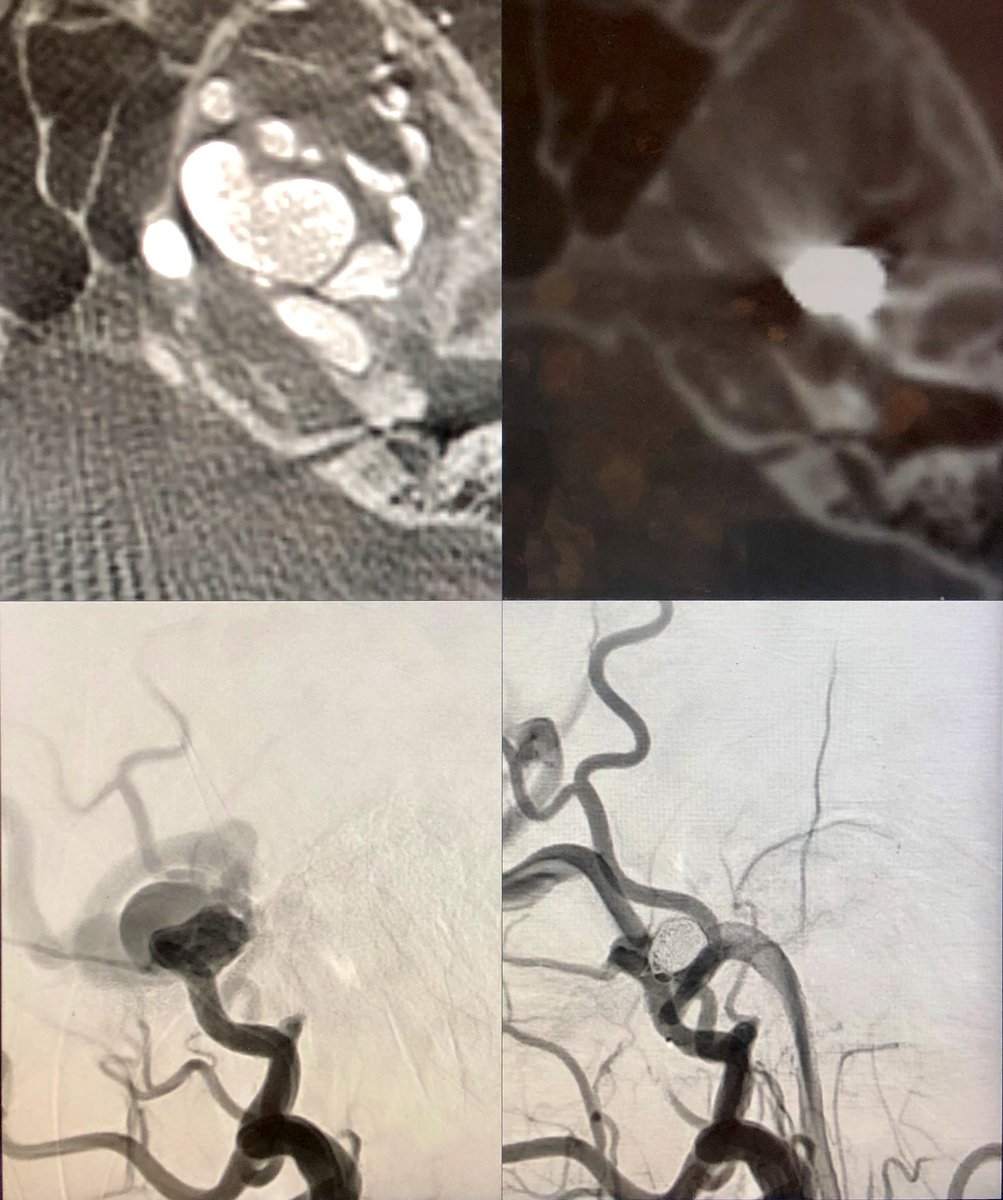 Cognard 4 / Borden 3 single hole dAVF arising from the petrosal MMA branch. 3 #microvention gel coils into the venous sac to #embolise and preserve petrosal branch and facial arcade #TRA #radialforneuro #withoutascalpel #oldbutgold. Patient home on same day. #MondayMotivaton